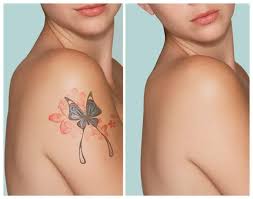 Laser Hair Removal